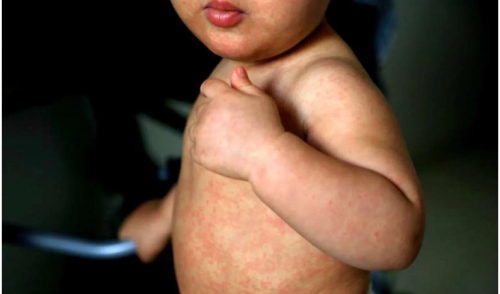 Ministerio de Salud insta a inmunizar a niños  contra el sarampión