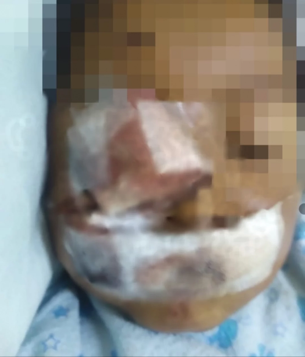 Niña de 3 años quedó con el rostro desfigurado tras ser atacada por su perro